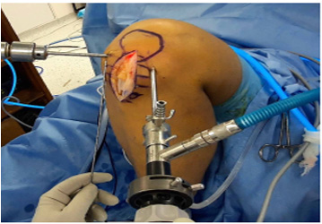 Arthroscopy Ligament Surgery