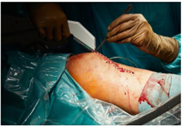 Arthroscopy Ligament Surgery