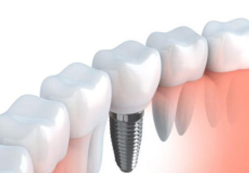 Dental implant