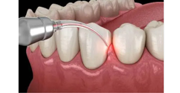 Periodontic Surgeries