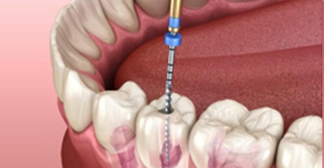 root canal treatment