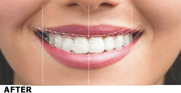 Best Smile Designing Treatment