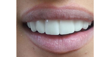 Teeth Whitening
